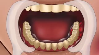 ASMR Treatment of Severe Tooth Decay so Satisfying