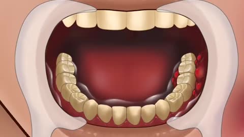 ASMR Treatment of Severe Tooth Decay so Satisfying