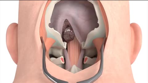 Craniectomy surgical procedure - 3D animation