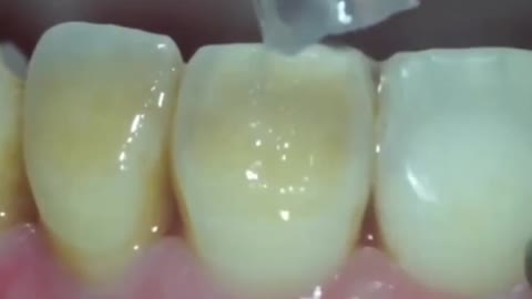 Scaling of teeth (III)