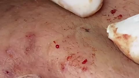 Relaxing SPA Pimple Popping videos l Relax Every Day With SPA #1