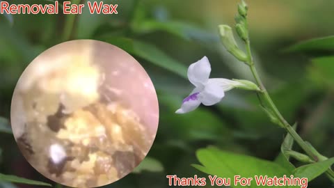 gigantic ear wax removal #5