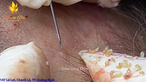 Black Head Removal