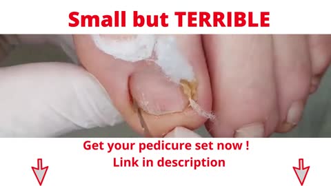 Small but terrible!! - Podology educational video