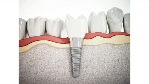 Michael L. Bleeker, DMD Scottsdale AZ Full Mouth Dental Implant Specialties