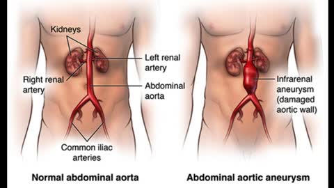 abdominal aortic aneurysm (AAA)