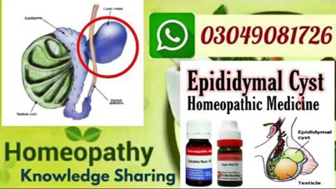 Male Infertility | epididymal cyst | cause, symptoms | Homeopatic medicine for epididymal cyst ??