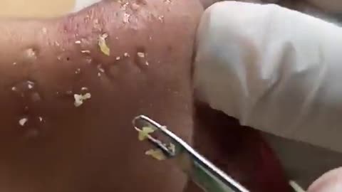 Removal Of Deep Blackheads On Nose