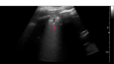 Lung Ultrasound Consolidation