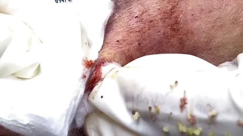 Big Cystic Acne Blackheads Extraction Blackheads & Milia, Whiteheads Removal Pimple Popping #095