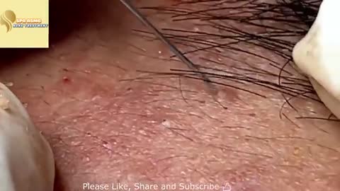 Big Blackhead removal