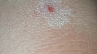 Oregano Oil Recurring Ingrown Hair