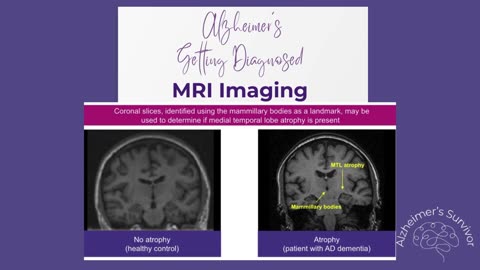 Diagnosing Alzheimer's Disease
