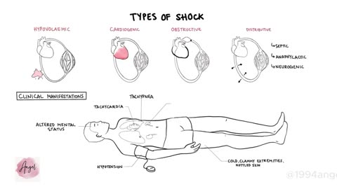 Approach to Shock - types, hypovolemic, cardiogenic, distributive, anaphylaxis, pathology, treatment