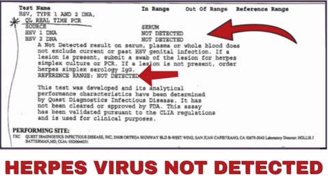 Herpes Simplex Virus NOT DETECTED Following Scalar Light Sessions - PCR Test Result