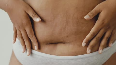 After Women Pregnancy Women's Body Strech Marks