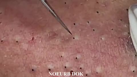 Blackhead removal