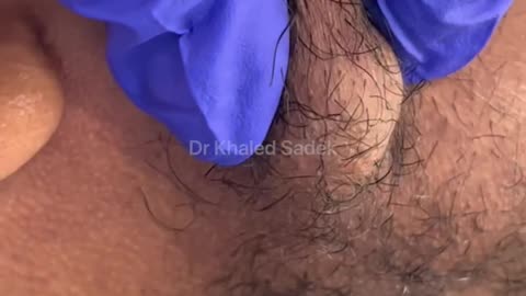 #skincare video out now Dr Khaled Sadek