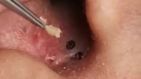 Crazy blackheads inside ear 👂they don’t want to come out #shorts #blackheads #blackheadremoval