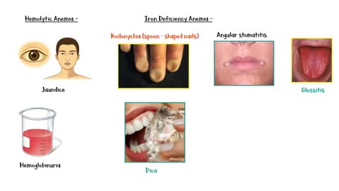 Common Signs & Symptoms Of Anemia _Iron Deficiency, Hemolytic & Other Anemias _ Anemia Symptoms