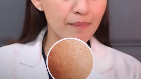 Open pores treatment/problem