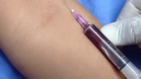 how to insert iv canulla