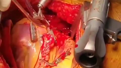 #Medical clip showing the agility and steadfastness of a surgeon stitching the heart as it beats.😷