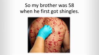 Got shingles? Do this now while you still can..