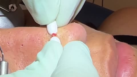 Deep waxy pore plugs removed. 20 minutes of extractions with MrPopZit