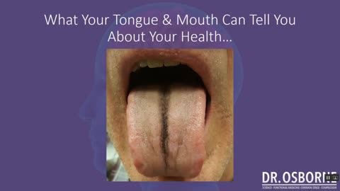 What you tongue and mouth can tell you about vitamin and mineral deficiencies