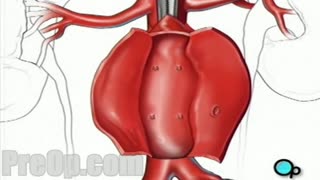 Abdominal Aortic Aneurysm - Open Repair Surgery