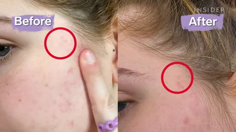 $10 Serum Wand Claims To Lighten Acne Scars _ The Zit Fix _ Beauty Insider