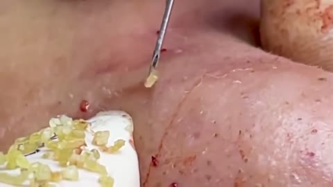 acne treatment nose blackheads