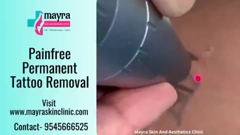 Pain Free Tattoo Removal Treatment