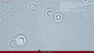 liveblood under a phasecontrast microscope. 5 days after incubator. Acanthocytes (Spur Cells)