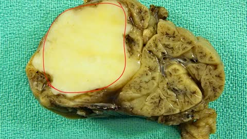 Salivary Glands Diseases