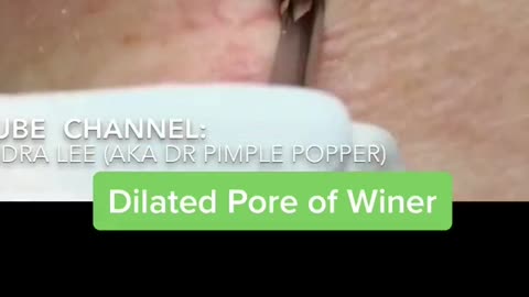 Nice Dilated pore of Winer aka big blackhead.