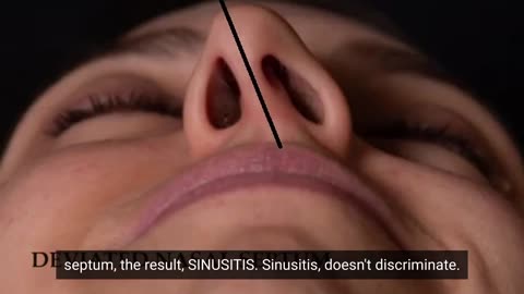 Let's talk about sinusitis, also known as a sinus infection - Dr Sharad ENT