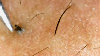 Removing the horrible Ingrown Hair root