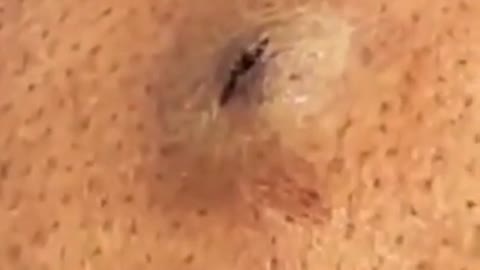 Blackhead Removal - Pimple popping - Acne Treatment - 31 #shorts