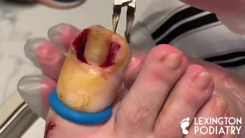 DEEP BLOODY INGROWN TOENAIL