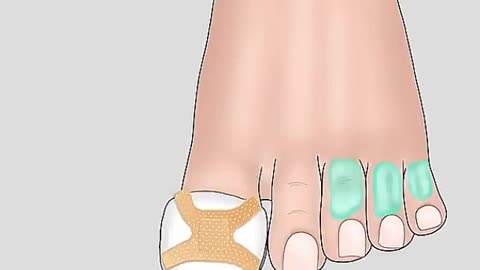 [ASMR] Help Kylian Mbappé Remove iron nails stuck in toenail