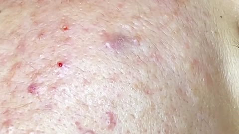 Relaxing SPA Pimple Popping videos l Relax Every Day With SPA #3