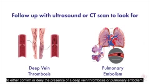 ER Physician on the large increase in EXTREMELY elevated D-Dimer test levels