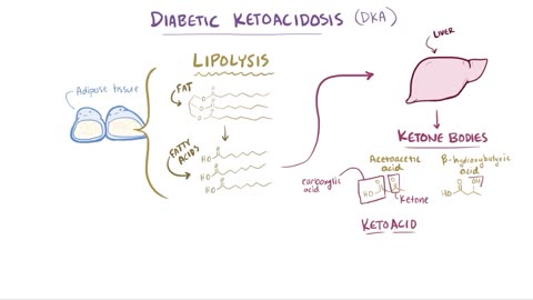 Diabetes mellitus (type 1, type 2) & diabetic ketoacidosis (DKA)