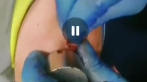 Vaccino anti covid: Guardate cosa è uscito dalla spalla inoculata (immagini forti)