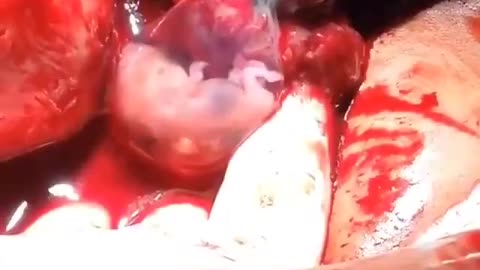 Amazing Video Shows Unborn Baby in First Trimester Moving Her Arms and Legs