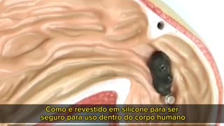 130 - Hidrogel e grafeno sendo usado dentro do corpo?