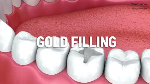 Dental Filling Options: A Brief Guide to Dental Restoration.