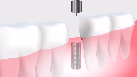 Dental Implants Procedure